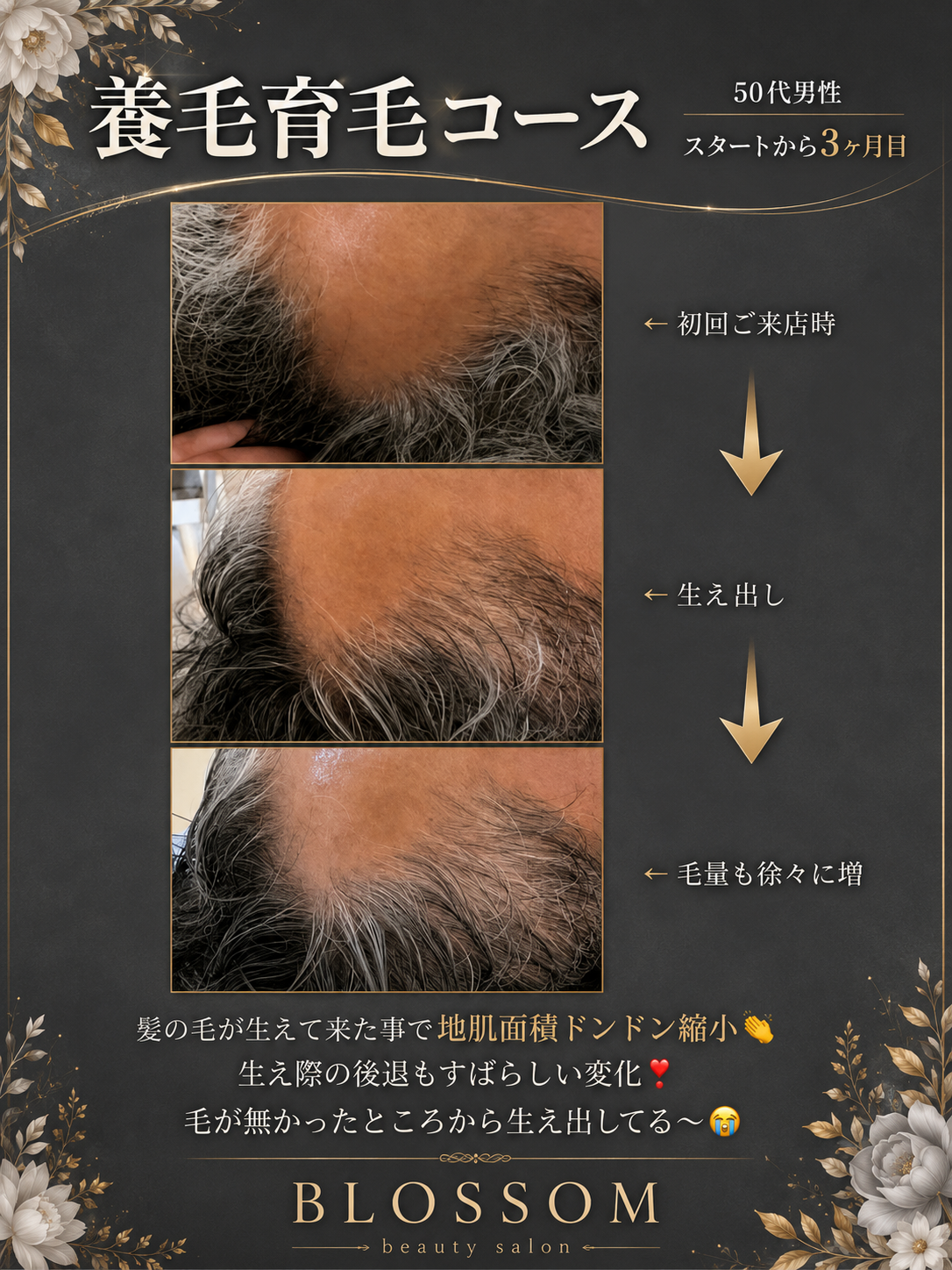 最新技術を用いた育毛施術